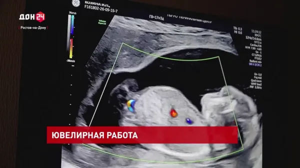 Внутриутробное переливание крови